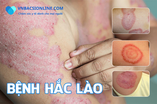 Địa chỉ bán thuốc hắc lào uy tín