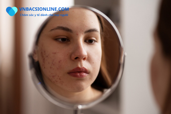 Những cách trị mụn hiệu quả