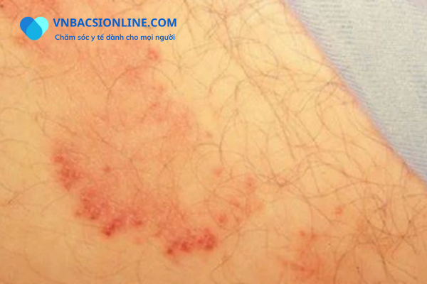 Thuốc trị nấm vùng kín nam giới