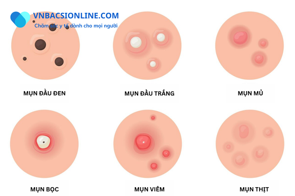 Những cách trị mụn hiệu quả nhất
