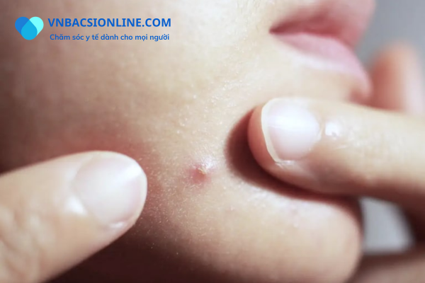 Cách trị mụn nội tiết dứt điểm
