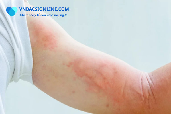 Nguyên nhân và cách điều trị mề đay