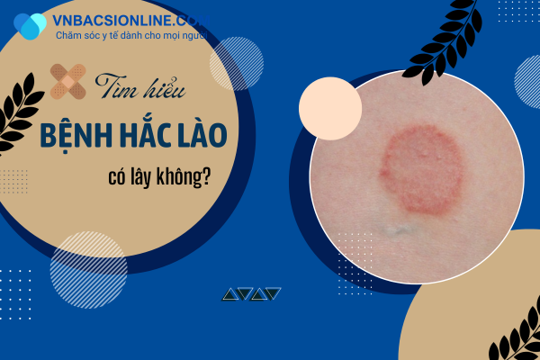 Bệnh hắc lào có lây không? Các chuyên gia chia sẻ