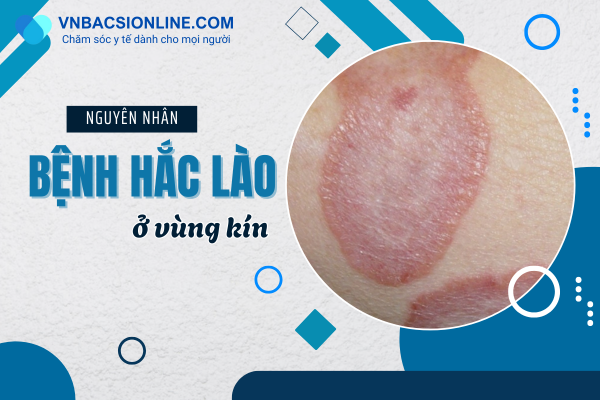 benh-hac-lao-o-vung-kin%20(1).png
