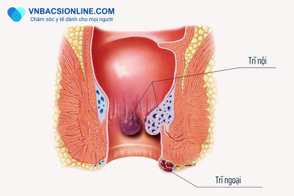 Các cách chữa bệnh trĩ không thể bỏ qua hiện nay
