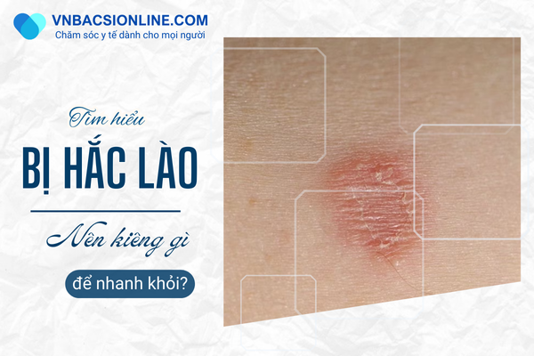 Bị hắc lào kiêng gì để tránh làm bệnh nặng hơn và nhanh khỏi?