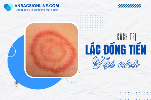 Những cách trị lác đồng tiền tại nhà hiệu quả và an toàn