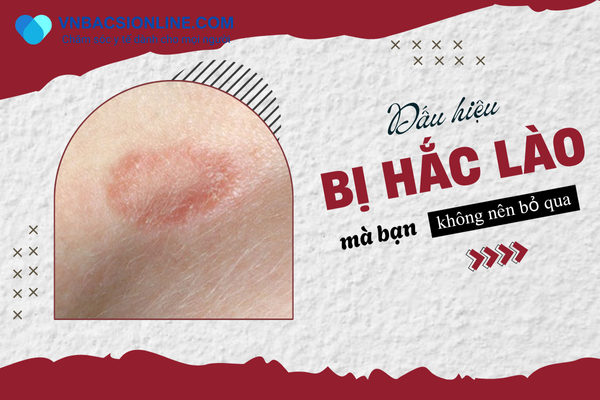 Dấu hiệu bị hắc lào: Hiểu biết và phòng tránh bệnh da liễu phổ biến