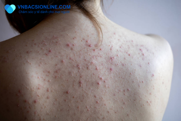 Dấu hiệu nhận biết tình trạng mụn ở lưng sớm nhất