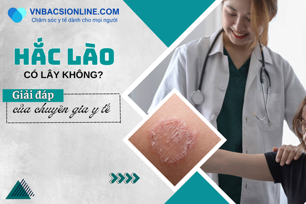 Bị hắc lào có lây không? Tất tần tật kiến thức cần biết