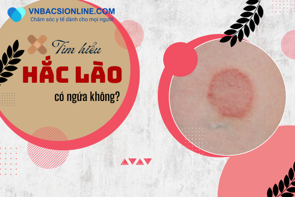 Hắc lào có ngứa không mẹo giảm ngứa và tránh lây lan
