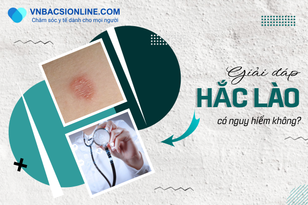 Hắc lào có nguy hiểm không nhìn từ góc độ chuyên gia y tế
