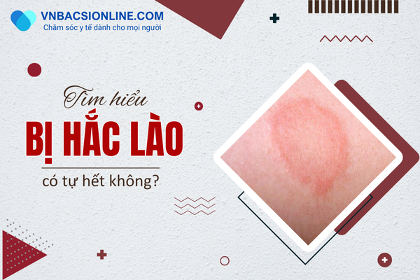 Có cần chữa hắc lào hay để tự khỏi được?