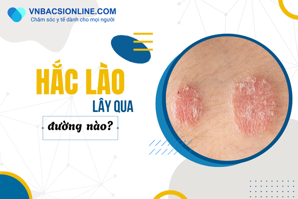 Hắc lào có thể lây qua những yếu tố nào bạn chưa biết?