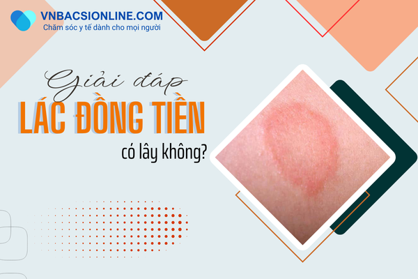 Lác đồng tiền có lây không và cách ngăn ngừa hiệu quả