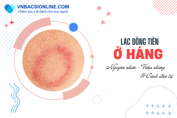 Tìm hiểu về lác đồng tiền ở háng và các phương pháp điều trị