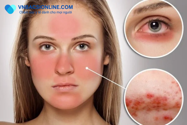 Lupus ban đỏ - Căn bệnh tự miễn vô cùng nguy hiểm