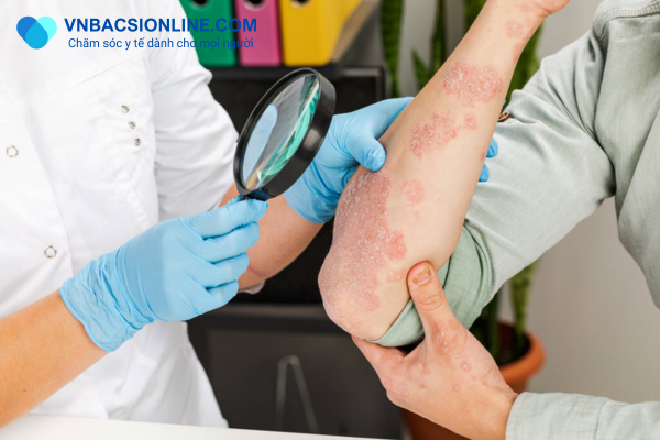 Một vài nguyên nhân gây mắc bệnh lupus ban đỏ