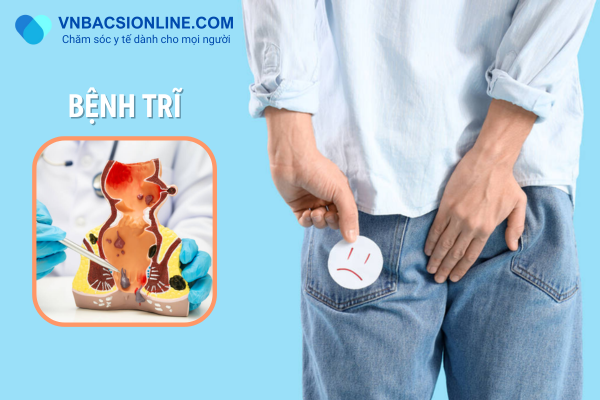 Hướng dẫn nhận biết bệnh trĩ và phòng tránh đúng cách