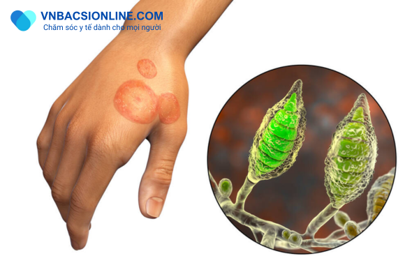 Cách chữa bệnh hắc lào tại nhà đúng cách